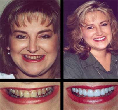 Restore Your Smile With Smile Makeover at Dumont Dentist