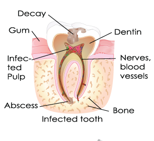 Root Canal in Bergenfield, NJ and Dumont, NJ