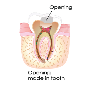 Stage 2 Of Root Canal in Dumont, NJ