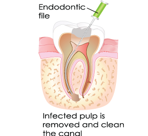 Stage 3 Of Root Canal in Bergenfield, NJ