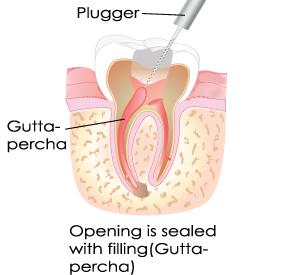 Root canal in Dumont, NJ