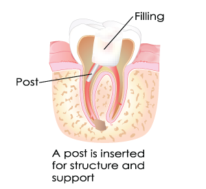 Inserted Posts During Root Canal Treatment in Dumont, NJ