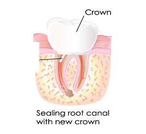 Sealing Root Canals With Crowns in Dumont, NJ